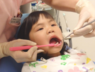小児歯科　フッ素
